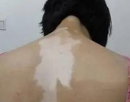 怎样合理的饮食可以预防白癜风的发生