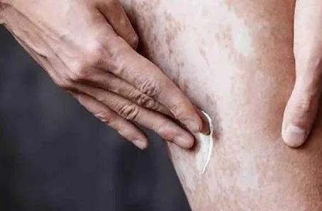 白癜风的护理方法有哪些?