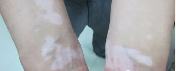 散发性白点癜风是什么引起的?